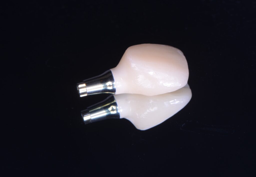Implants dentaires. Quelles Etapes ?