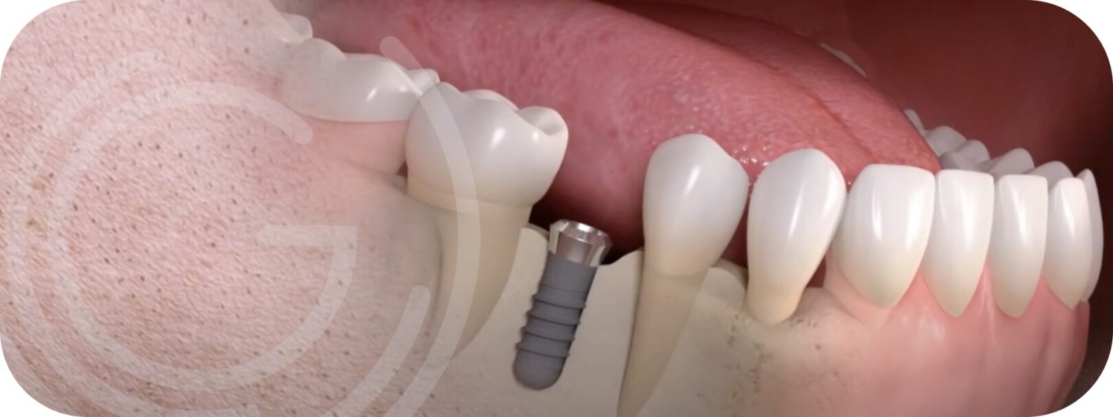 Les conséquences du non-remplacement des dents extraites ou absentes –  L'Information Dentaire