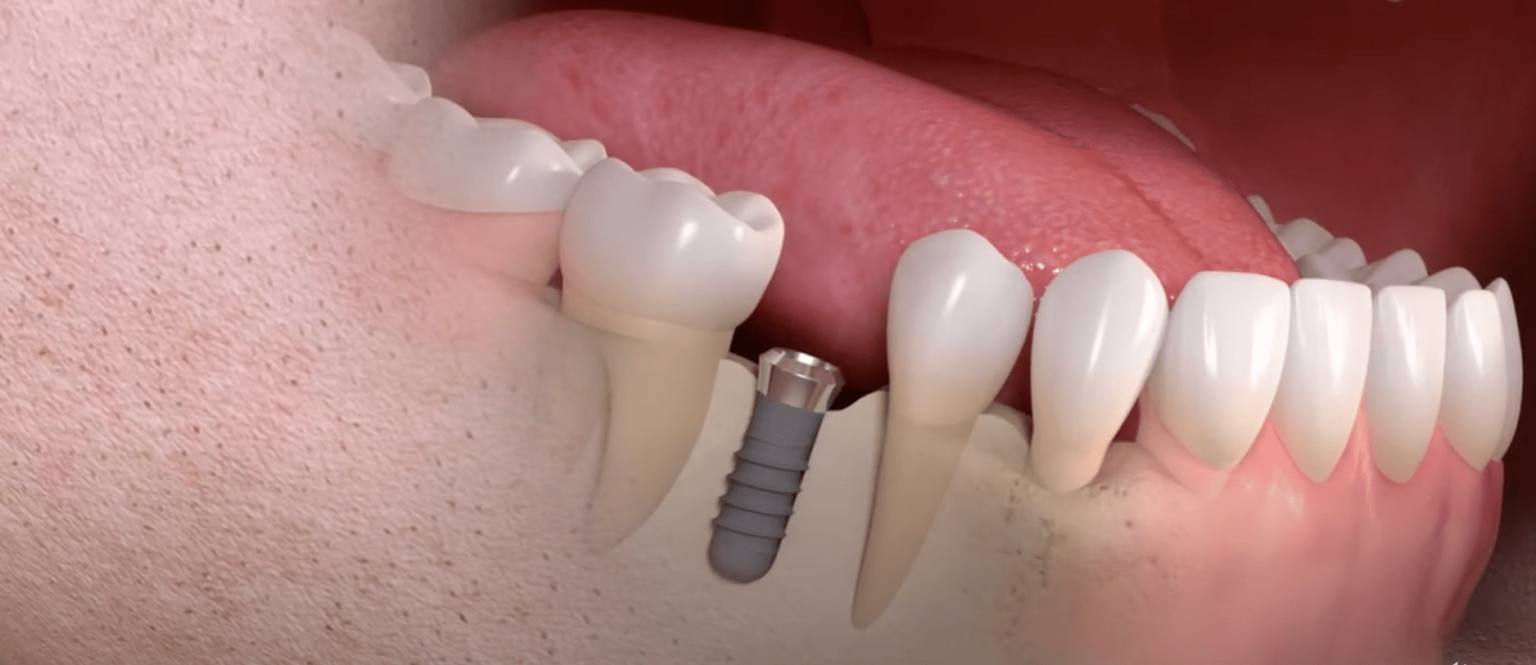 Implants dentaires. Quelles Etapes ? Chirurgiendentiste Dr Finelle