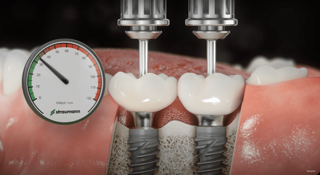 Implants dentaires. Quelles Etapes ?
