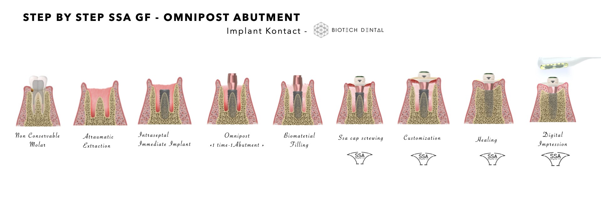 Protocole SSA GF Implant Dentaire Paris 7 Dr Gary Finelle protocole-ssa-gf-implant-dentaire-paris-7-dr-gary-finelle